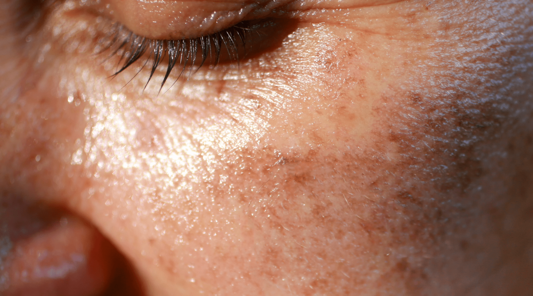 TREATING & PREVENTING HYPERPIGMENTATION - MIE Skincare