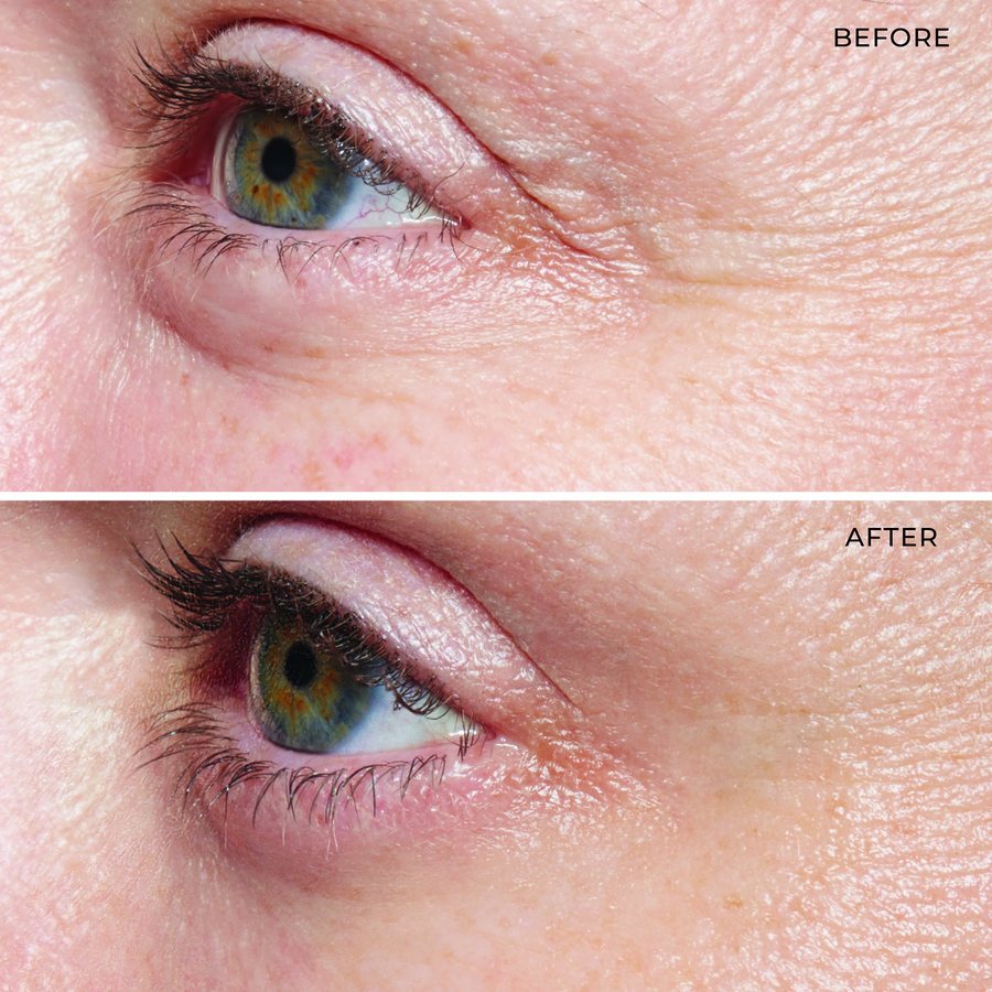 De-Puffing Eye Serum: 39% fewer wrinkles in 6 weeks, measured against a placebo.