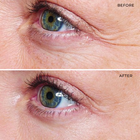 Before and after using Firming Eye Serum