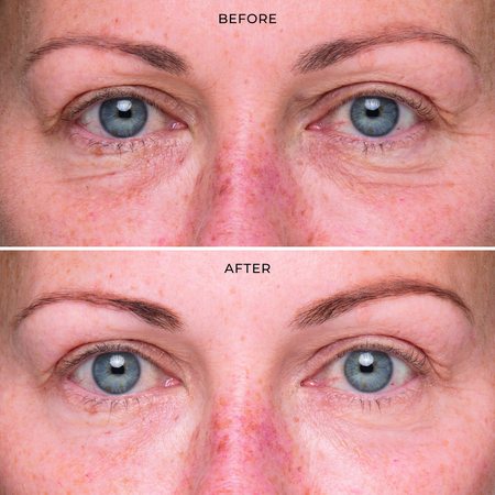 Before and after using Triple Complex Eye Serum